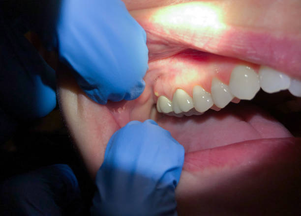 Best Emergency Wisdom Tooth Extraction in North Highlands, CA